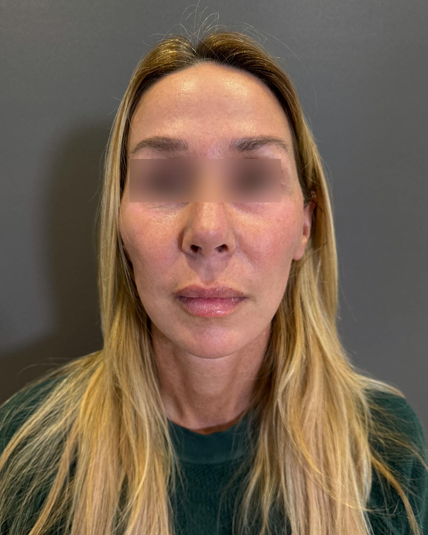 Eyelid Surgery Before & After Gallery - Patient 268821 - Image 6
