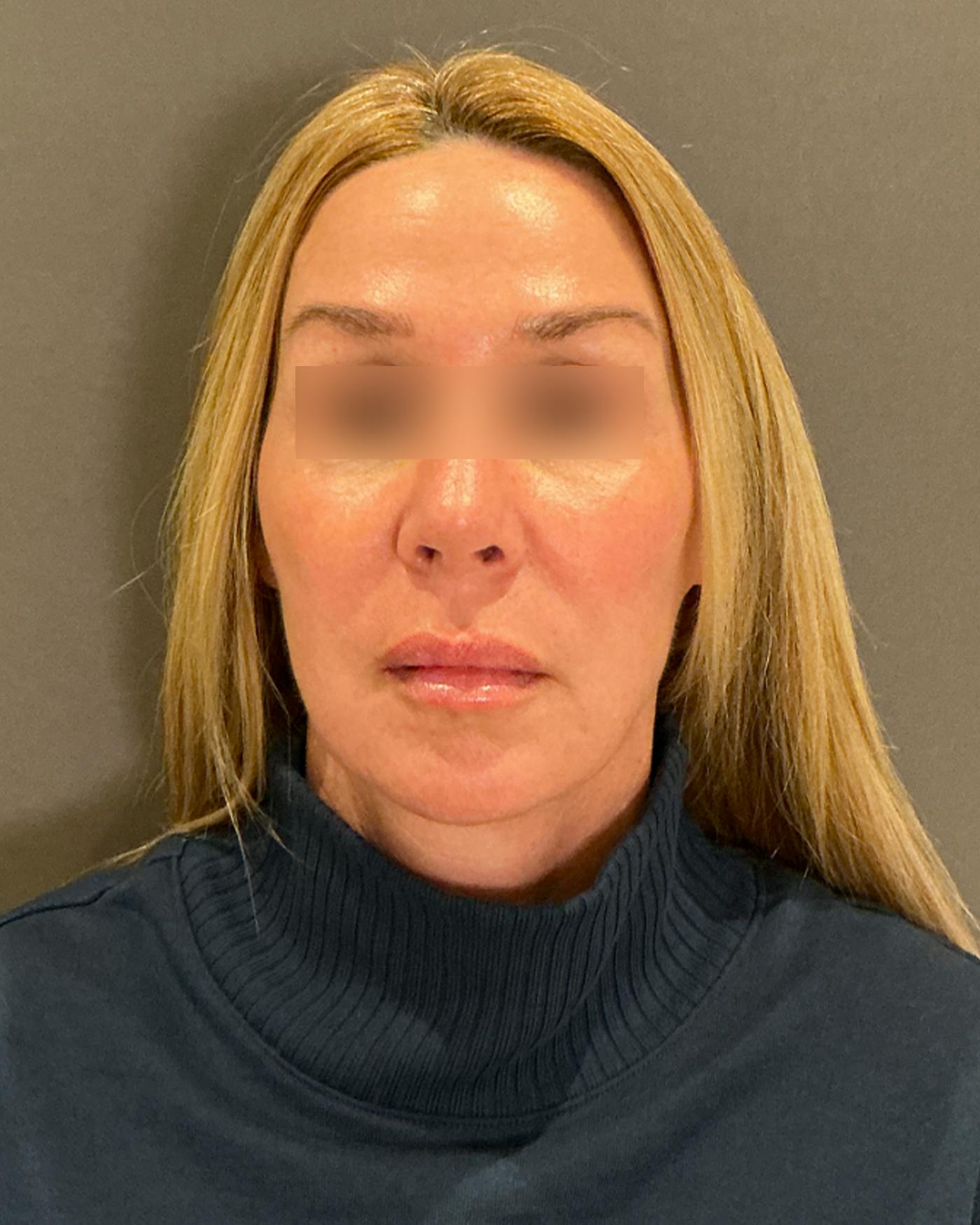 Eyelid Surgery Before & After Gallery - Patient 268821 - Image 5