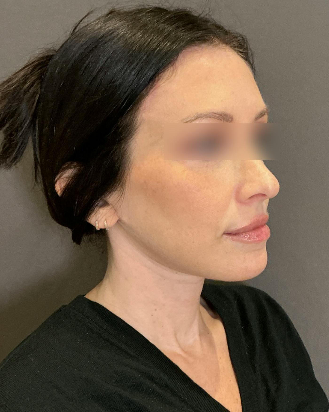 Brow Lift Before & After Gallery - Patient 146829 - Image 2