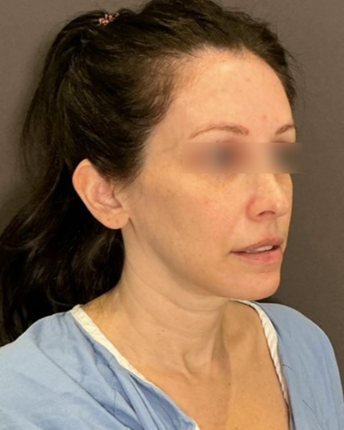 Brow Lift Before & After Gallery - Patient 146829 - Image 1