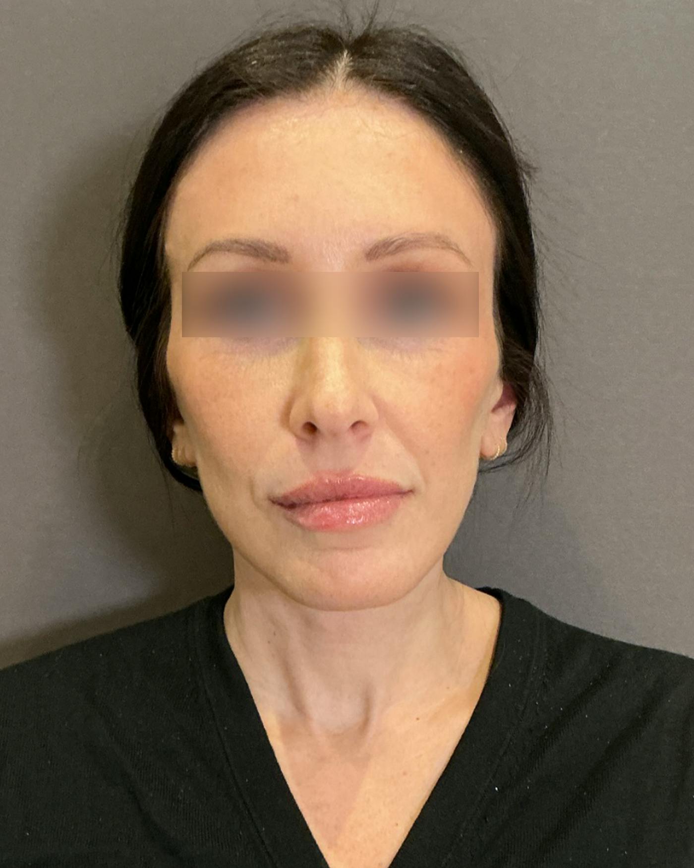 Brow Lift Before & After Gallery - Patient 146829 - Image 6