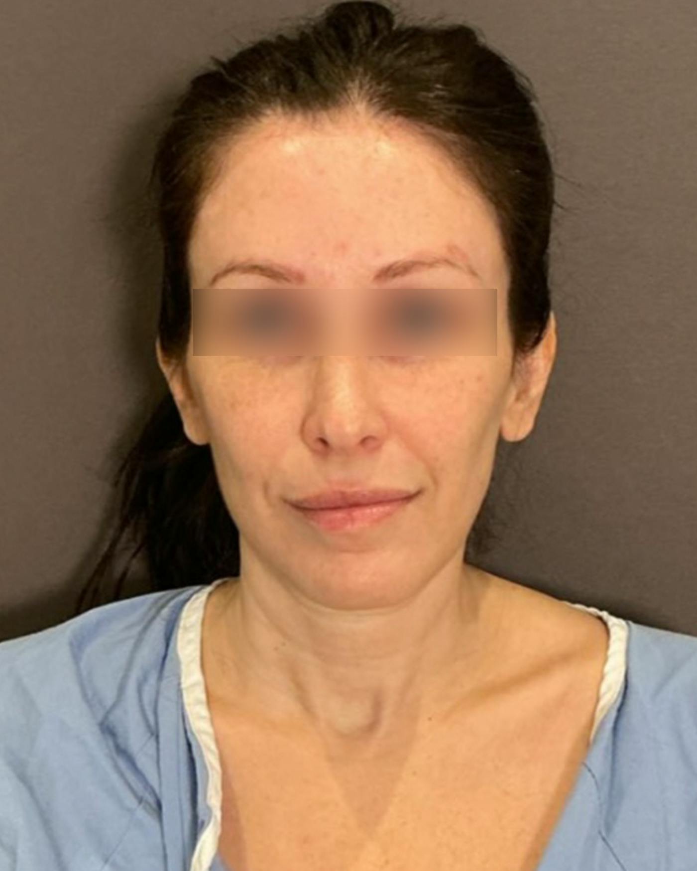 Brow Lift Before & After Gallery - Patient 146829 - Image 5