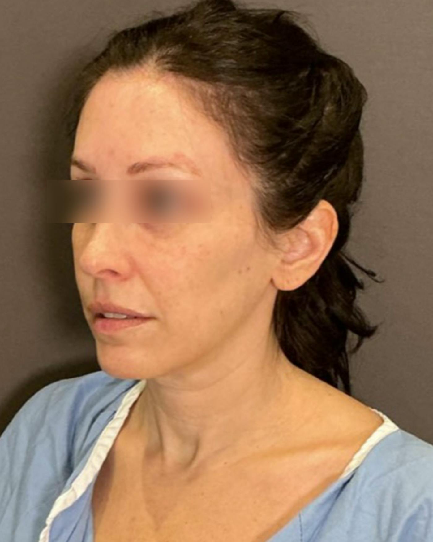 Brow Lift Before & After Gallery - Patient 146829 - Image 7