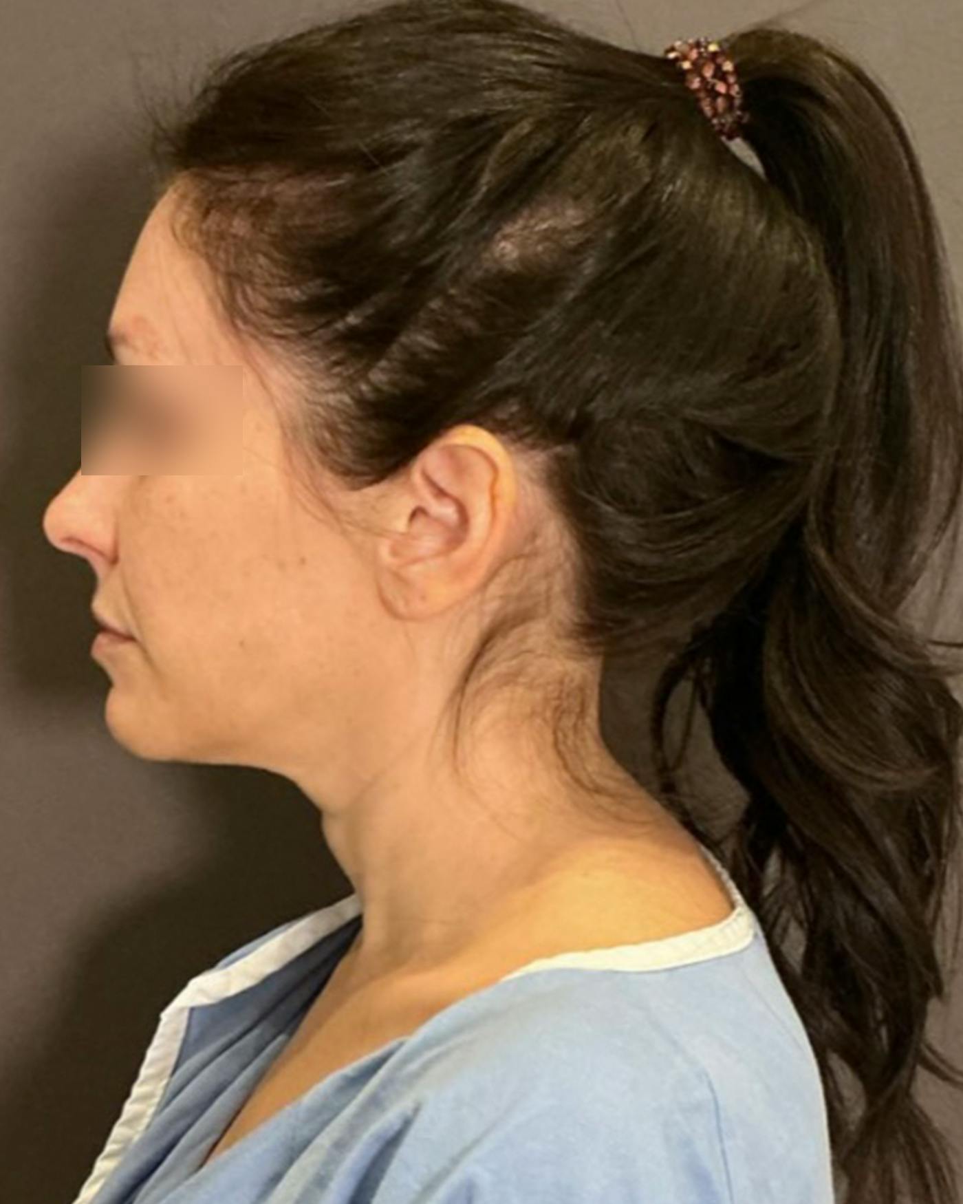 Brow Lift Before & After Gallery - Patient 146829 - Image 9