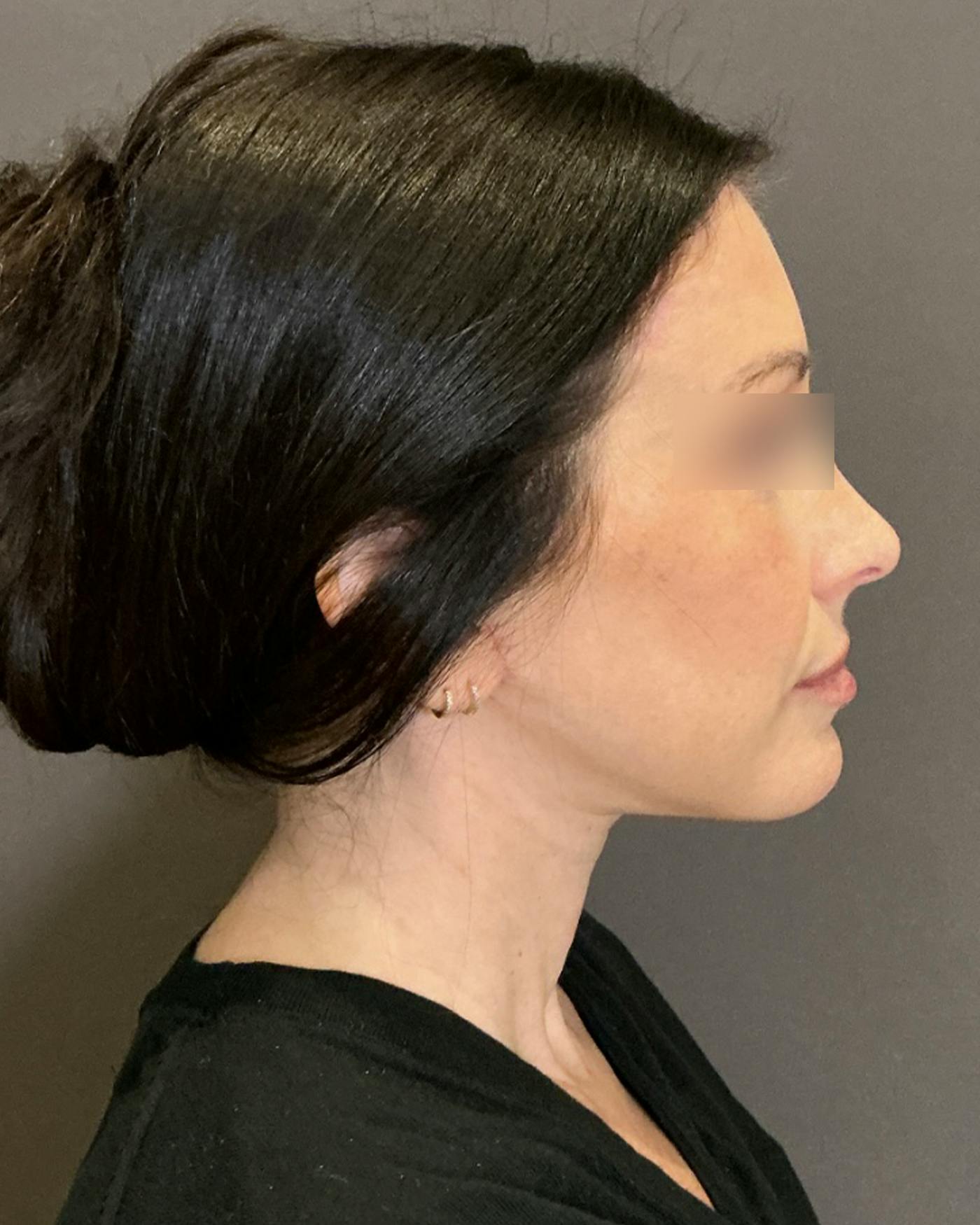 Brow Lift Before & After Gallery - Patient 146829 - Image 4