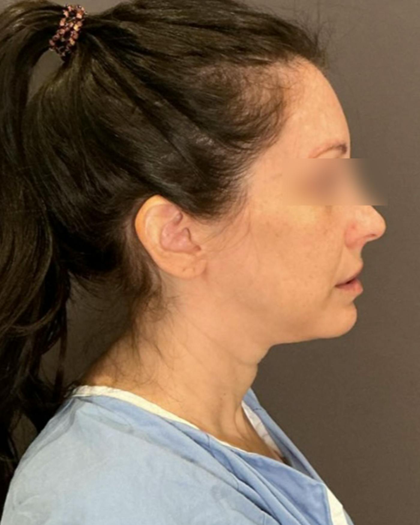 Brow Lift Before & After Gallery - Patient 146829 - Image 3