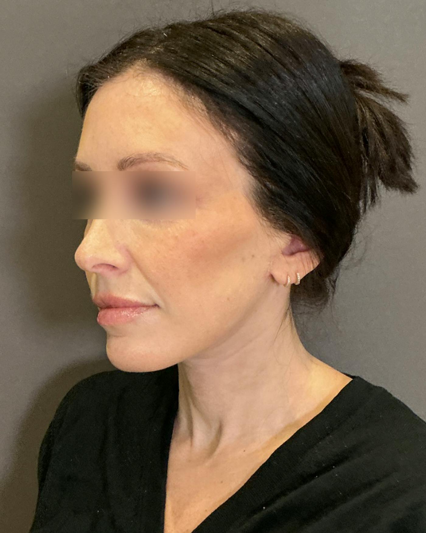 Brow Lift Before & After Gallery - Patient 146829 - Image 8