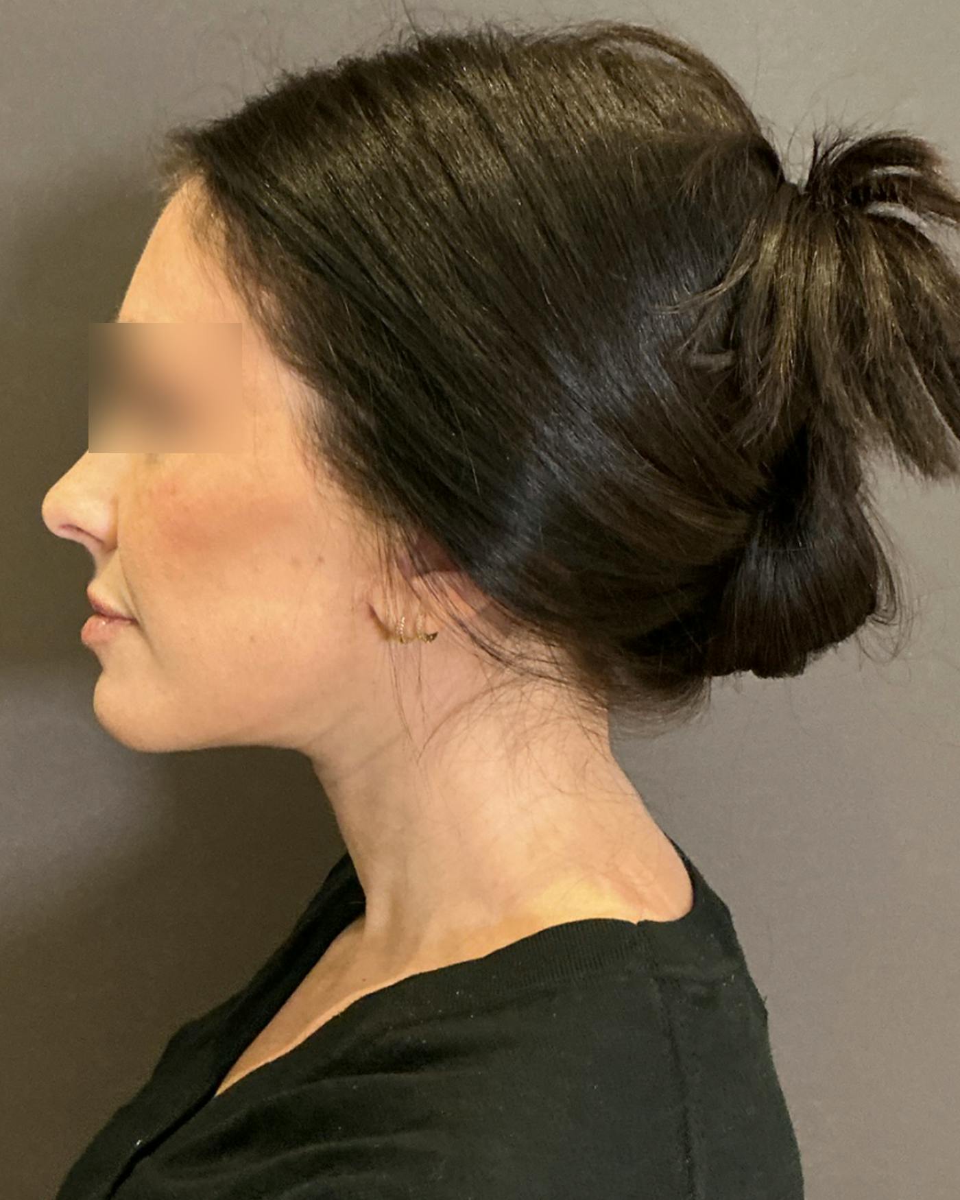 Brow Lift Before & After Gallery - Patient 146829 - Image 10