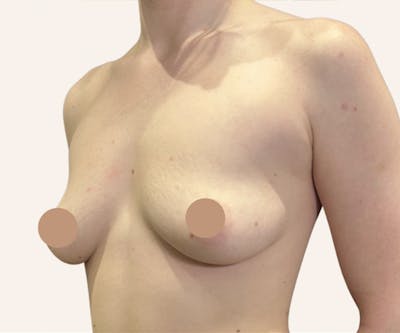 Breast Augmentation Before & After Gallery - Patient 304446 - Image 1