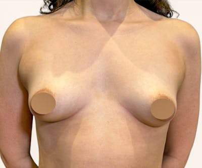 Breast Augmentation Before & After Gallery - Patient 309683 - Image 1