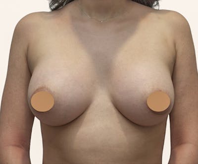 Breast Augmentation Before & After Gallery - Patient 309683 - Image 2