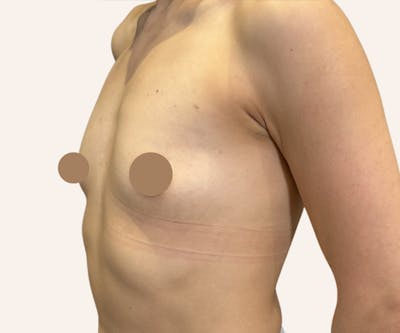 Breast Augmentation Before & After Gallery - Patient 441882 - Image 1