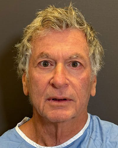 Facial Fat Transfer Before & After Gallery - Patient 244414 - Image 1