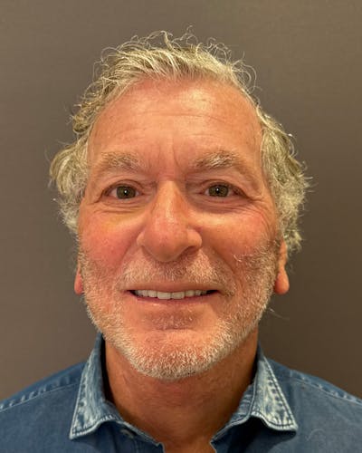 Facial Fat Transfer Before & After Gallery - Patient 244414 - Image 2