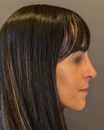 Rhinoplasty Before & After Gallery - Patient 272636 - Image 2