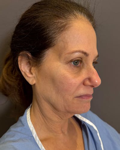 Eyelid Surgery Before & After Gallery - Patient 327634 - Image 1