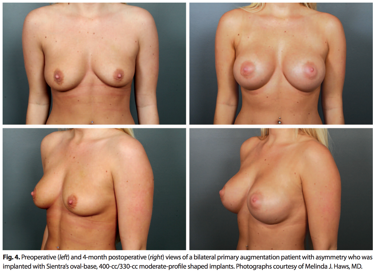 Before and After Breast Implants