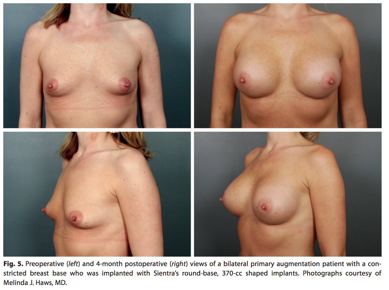 Before and After Breast Implants