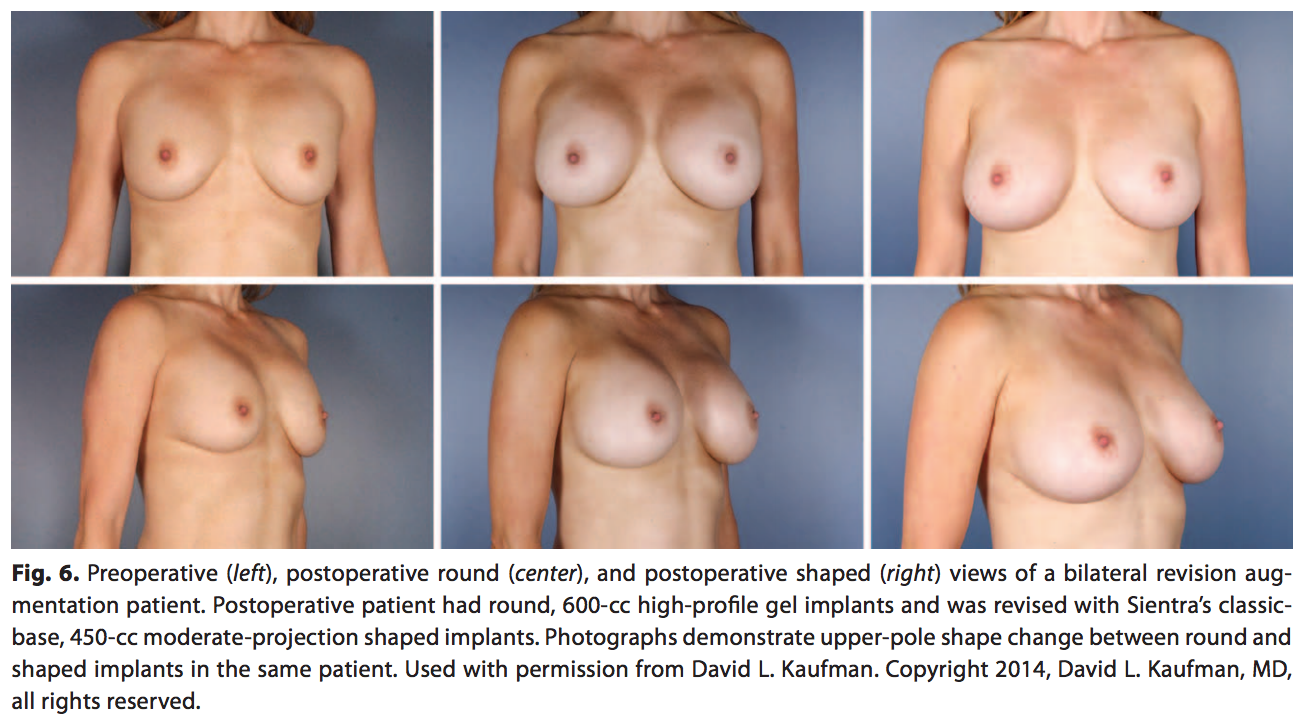 Before and After Breast Implants