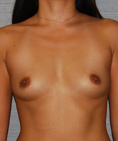 Breast Augmentation Before & After Gallery - Patient 133023397 - Image 1