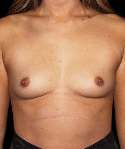 Breast Augmentation Before & After Gallery - Patient 133023405 - Image 1