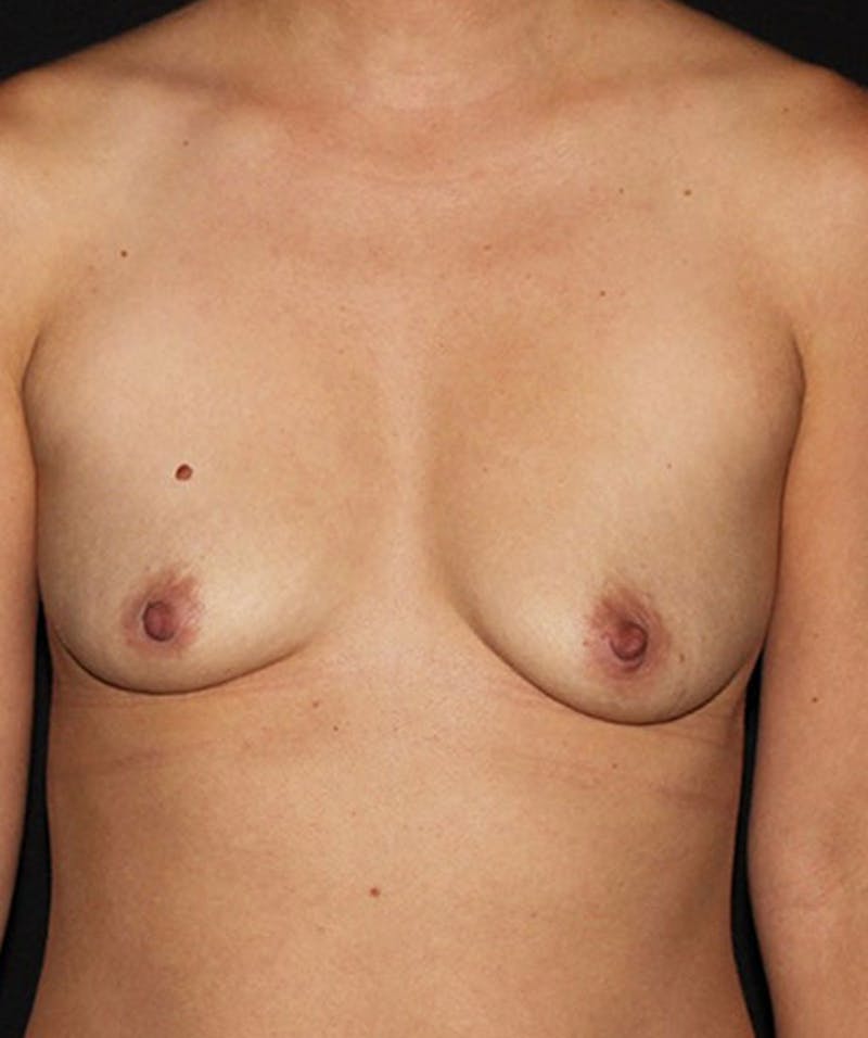 Breast Augmentation Before & After Gallery - Patient 133023420 - Image 1