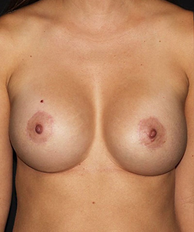 Breast Augmentation Before & After Gallery - Patient 133023420 - Image 2