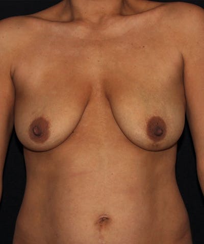 Breast Lift with Implants Before & After Gallery - Patient 133023435 - Image 1