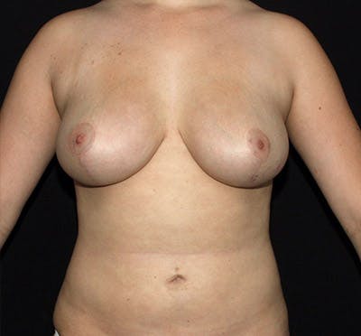 Breast Lift Before & After Gallery - Patient 133023434 - Image 2