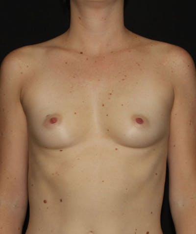 Breast Augmentation Before & After Gallery - Patient 133023439 - Image 1