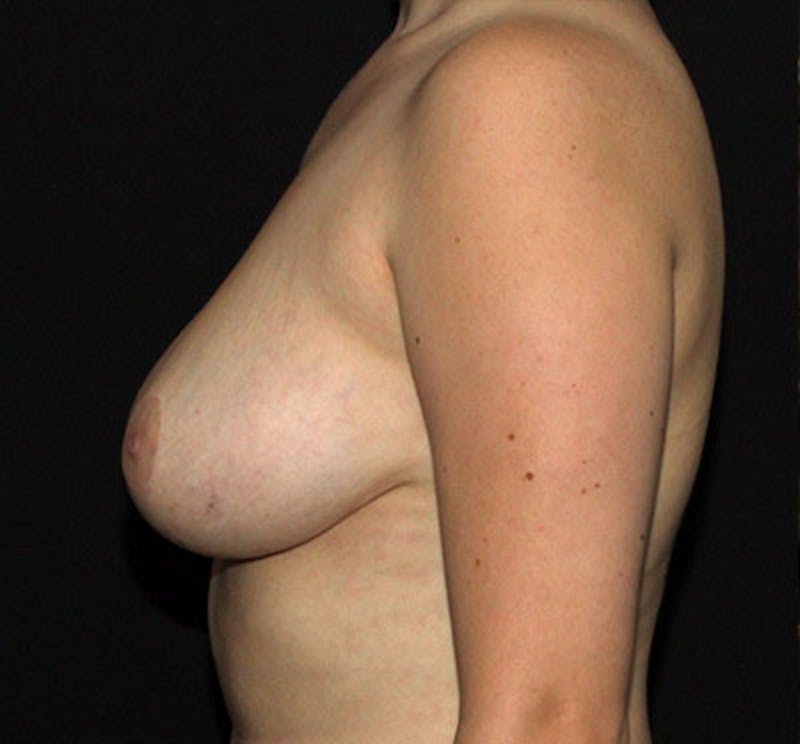 Breast Lift Before & After Gallery - Patient 133023434 - Image 6