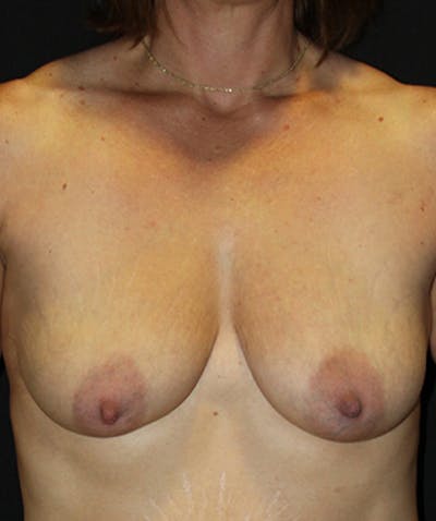 Breast Lift with Implants Before & After Gallery - Patient 133023442 - Image 1