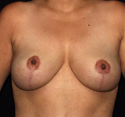 Breast Lift Before & After Gallery - Patient 133023444 - Image 2