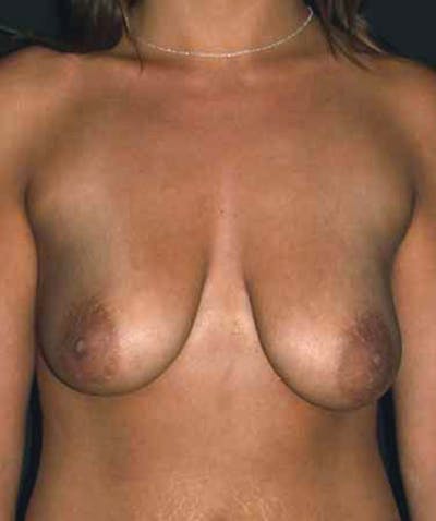 Breast Lift with Implants Before & After Gallery - Patient 133023453 - Image 1