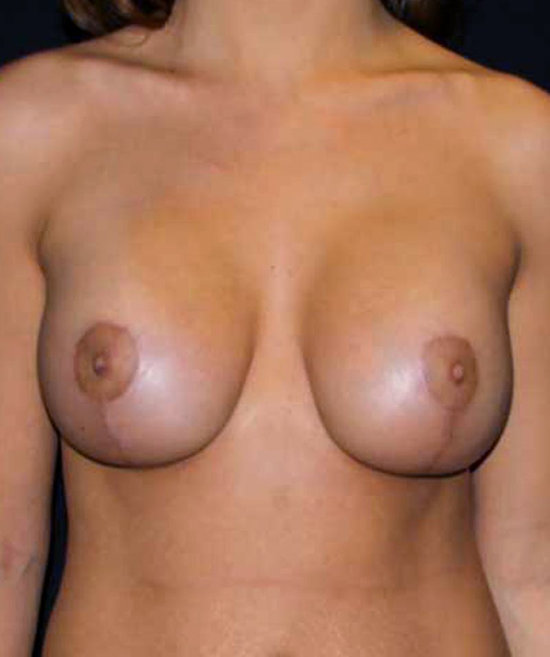 Breast Lift with Implants Before & After Gallery - Patient 133023453 - Image 2