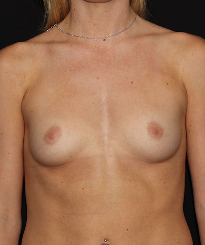 Sientra Breast Implants Before & After Gallery - Patient 133023455 - Image 1