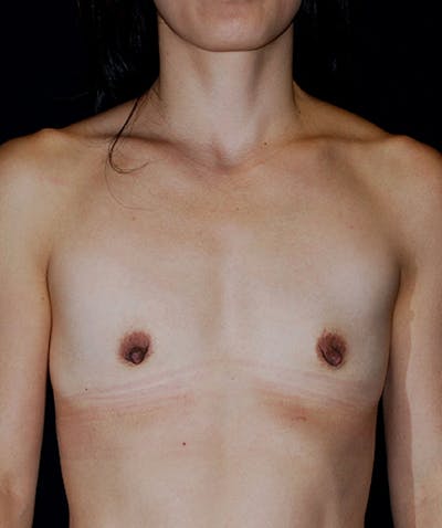 Breast Augmentation Before & After Gallery - Patient 133023456 - Image 1