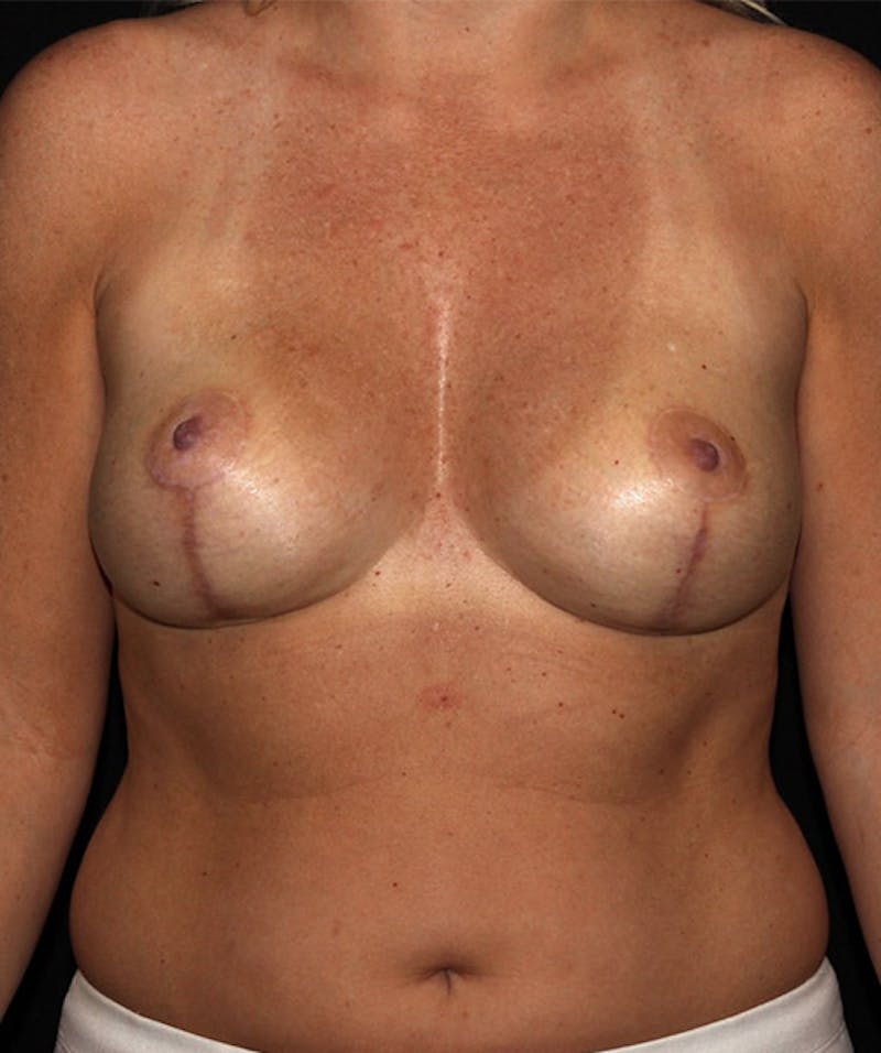 Breast Reduction Before & After Gallery - Patient 133023454 - Image 2