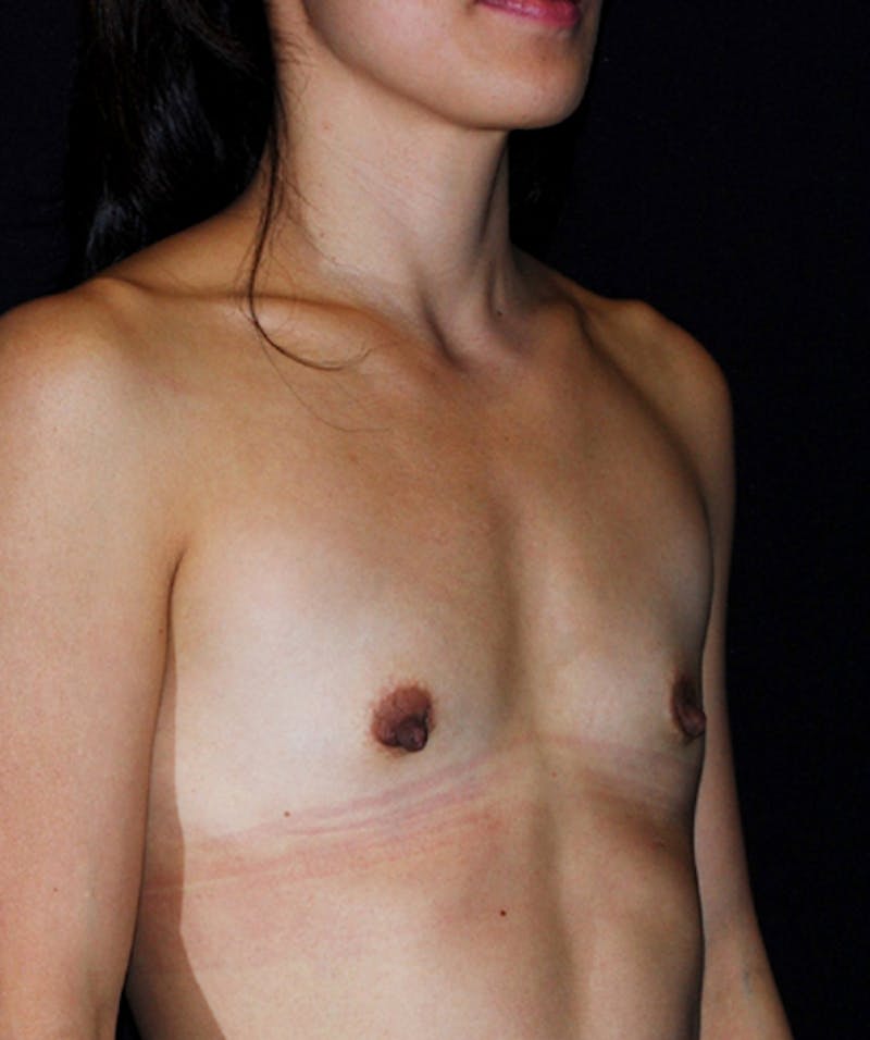Breast Augmentation Before & After Gallery - Patient 133023456 - Image 3