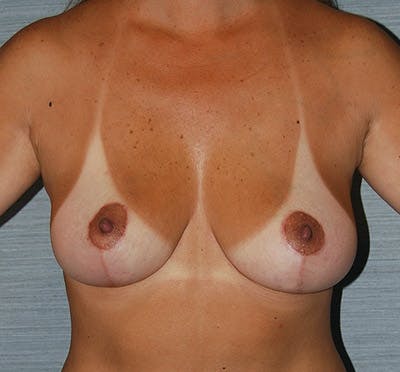 Breast Lift Before & After Gallery - Patient 133023460 - Image 2