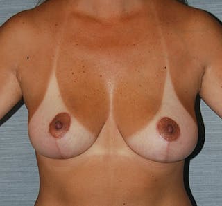 Breast Lift Before & After Gallery - Patient 133023460 - Image 2