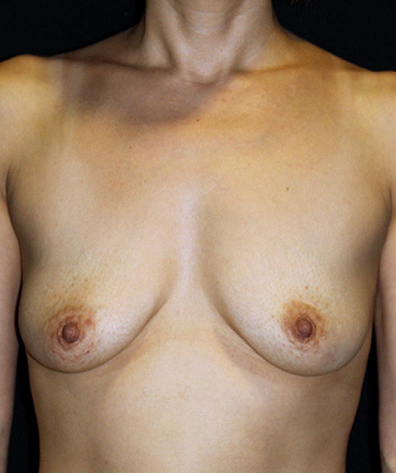Breast Lift with Implants Before & After Gallery - Patient 133023461 - Image 1