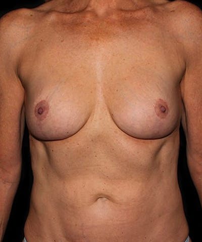 Breast Implant Removal Before & After Gallery - Patient 133023457 - Image 2