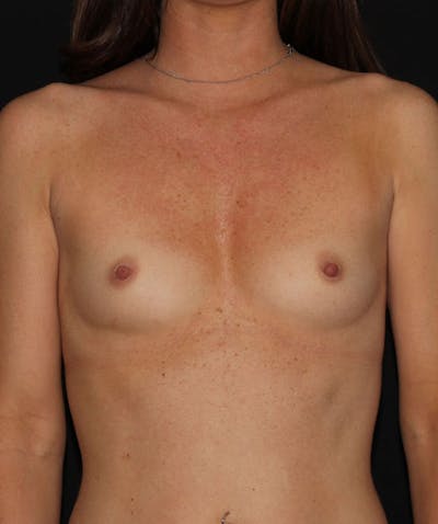 Sientra Breast Implants Before & After Gallery - Patient 133023463 - Image 1
