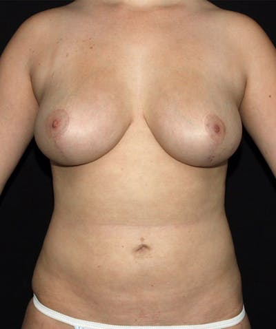Breast Reduction Before & After Gallery - Patient 133023462 - Image 2