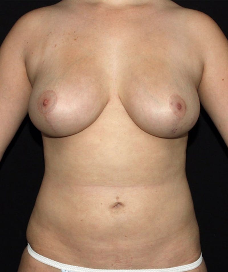 Breast Reduction Before & After Gallery - Patient 133023462 - Image 2
