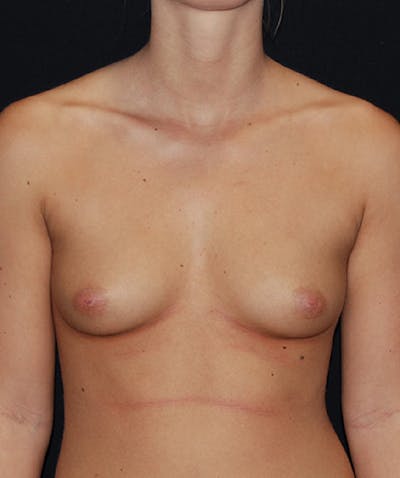Breast Augmentation Before & After Gallery - Patient 133023465 - Image 1