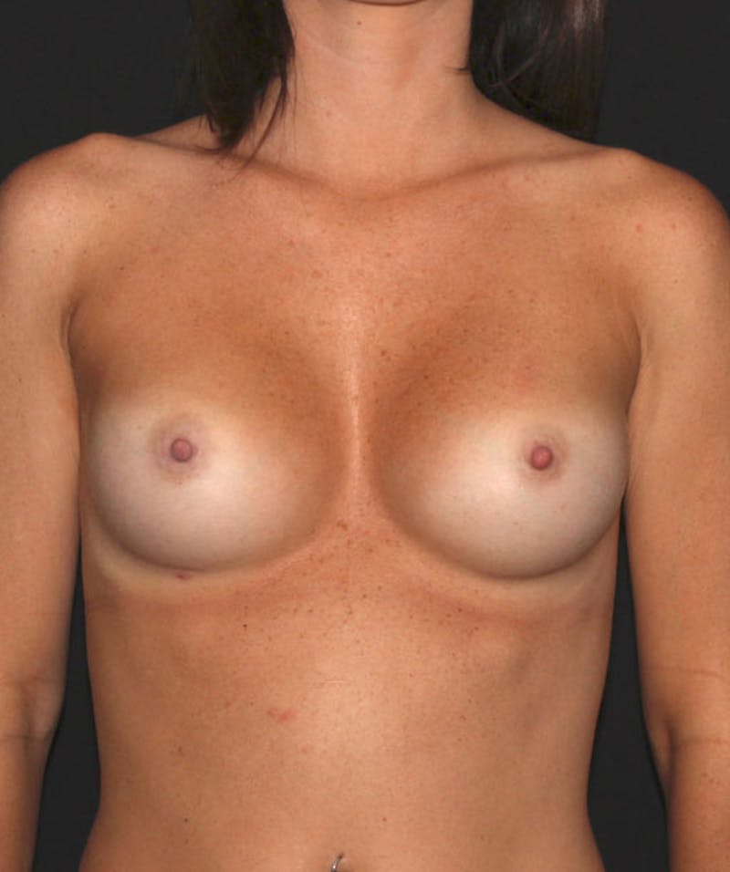 Sientra Breast Implants Before & After Gallery - Patient 133023463 - Image 2