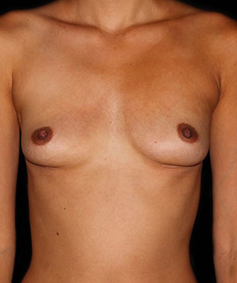 Breast Implant Removal Before & After Gallery - Patient 133023459 - Image 2