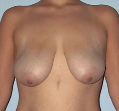 Breast Lift Before & After Gallery - Patient 133023466 - Image 1